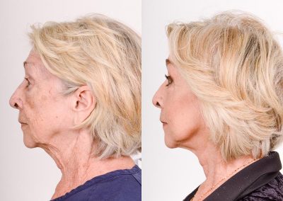 Facelift Before After P5 4