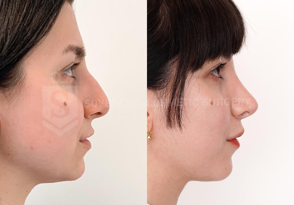 Rhinoplasty Before After P42 4