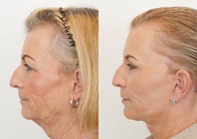 Facelift Before After P