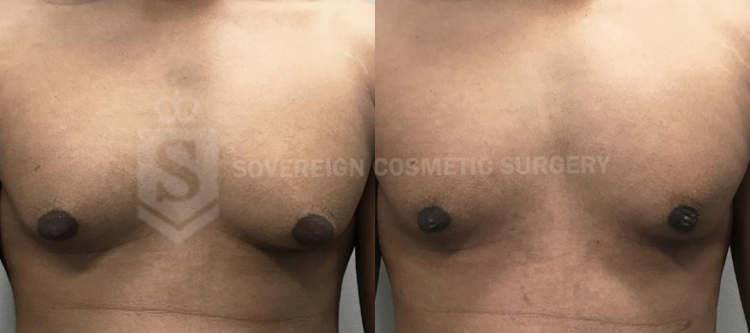 Male Breast Reduction Before and After 2