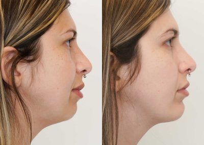 Chin Implant Before After P10 (2)