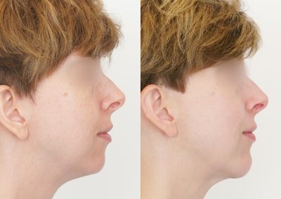 Chin Implant Before After P11