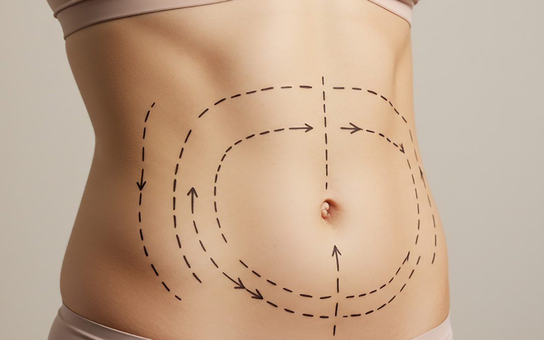 What to Expect During Your Abdominoplasty Recovery in Toronto – A Week-by-Week Guide