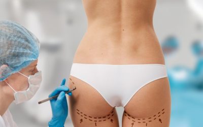 Are Brazilian Butt Lifts in Toronto Suitable for You?