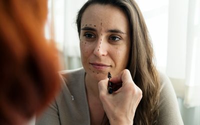 What to Know Before Buccal Fat Removal in Toronto