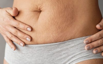 What a Toronto Tummy Tuck Scar Really Looks Like Over Time