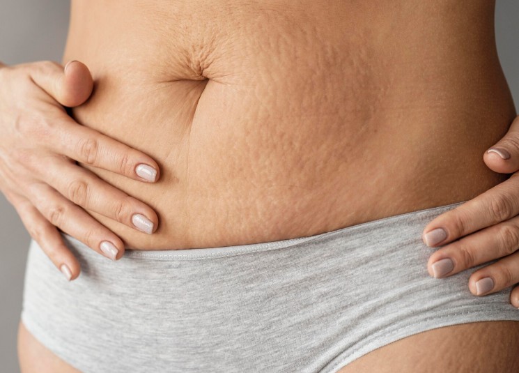 What a Toronto Tummy Tuck Scar Really Looks Like Over Time