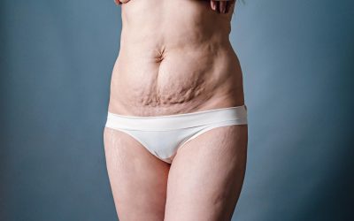 Preparing for a Mommy Makeover in Toronto After C-Section Births