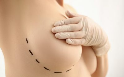 Recognizing When Breast Reduction in Toronto Becomes a Health Priority
