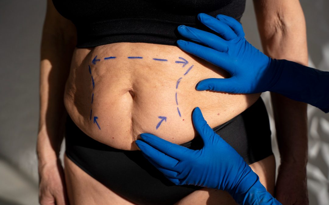 Subtle Breast Enhancement in Toronto Without Going up a Size