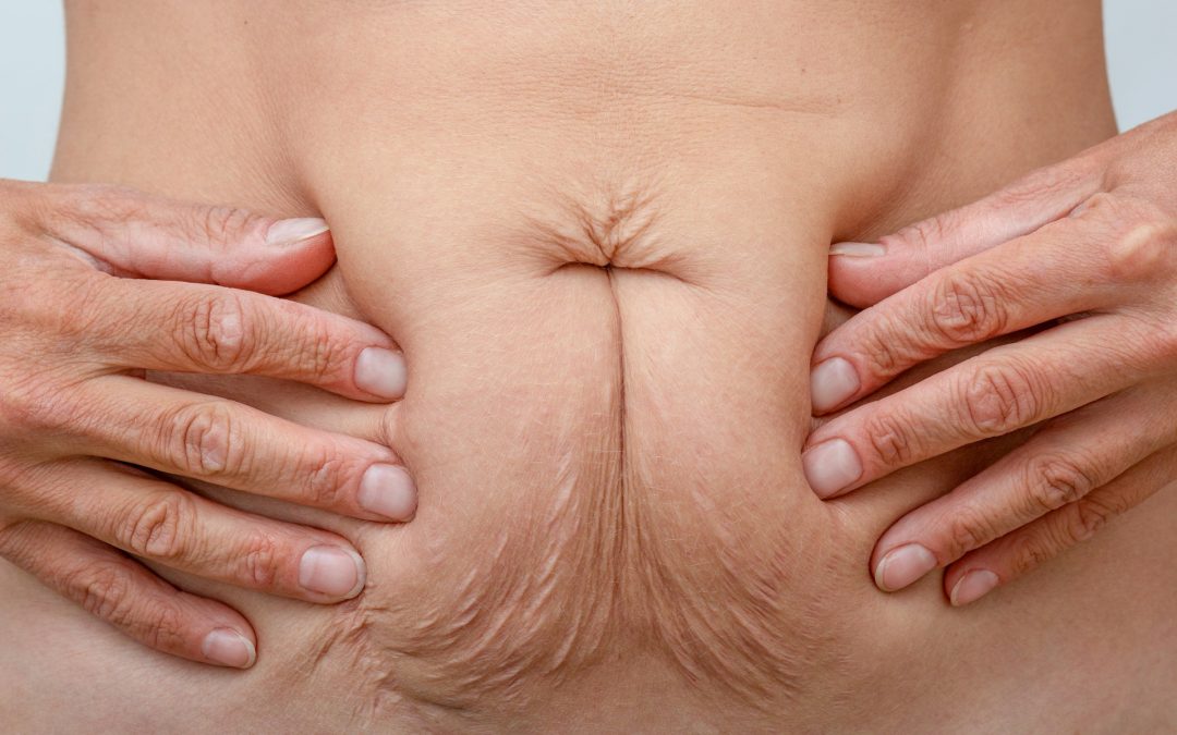 Why Torontonians Choose Abdominoplasty for Long-Term Core Support