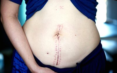 Planning Abdominoplasty in Toronto Around Cottage and Beach Season