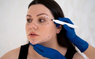Mini Facelift Recovery in Toronto: Downtime, Swelling Timeline, Natural Results