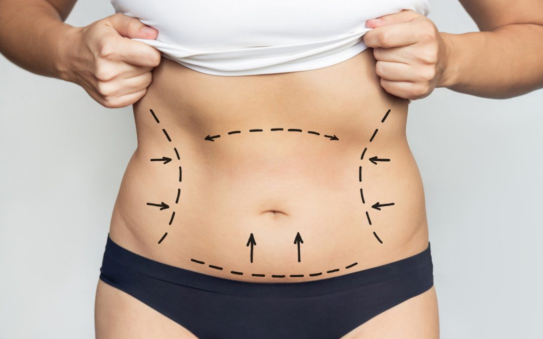 Beyond the Belly: How Abdominoplasty in Toronto Shapes the Waistline