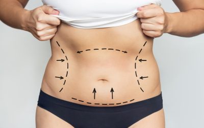 Beyond the Belly: How Abdominoplasty in Toronto Shapes the Waistline