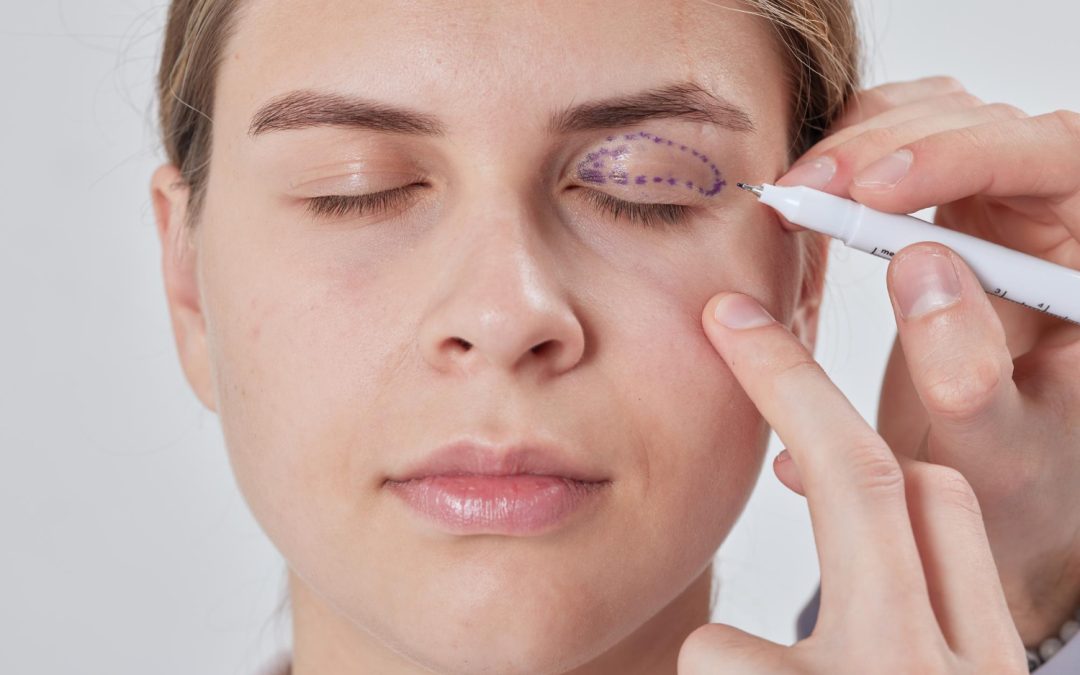 Blepharoplasty