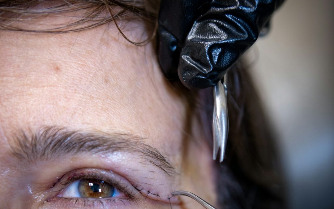 Eyelid Surgery